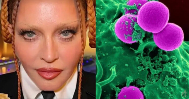 Doença de Madonna: o que é, sintomas e como prevenir a infecção bacteriana que levou cantora à UTI