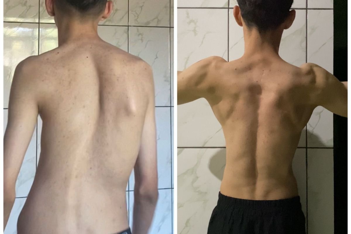 Imagem colorida de jovem magro com escoliose na esquerda e jovem forte na direita - Metrópoles