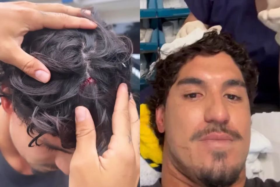 Gabriel Medina se acidenta durante surfe e é ferido na cabeça; foto | Metrópoles