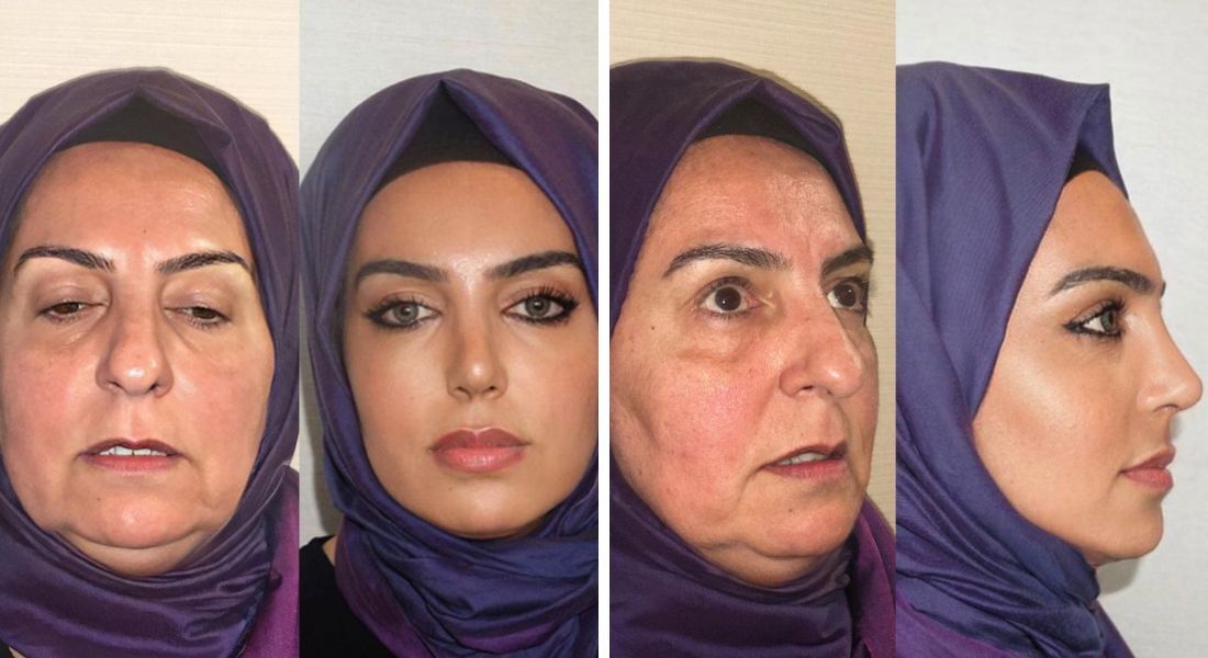 Antes e depois de cirurgia plástica em mulher de 68 anos viraliza - Folha PE