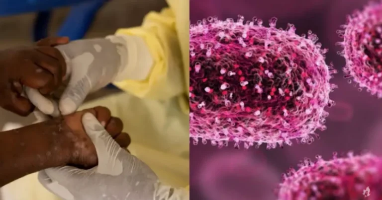 A Mpox chegou: A nova Varíola dos Macacos está causando preocupação pelo mundo