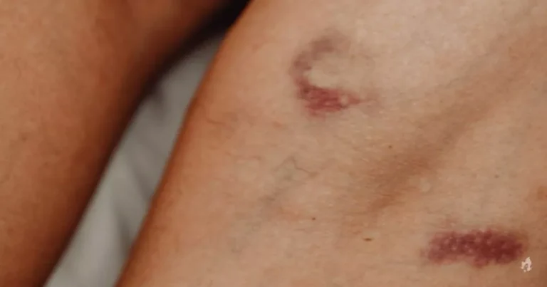 Em seu corpo surgem hematomas de maneira misteriosa? Então sua saúde pode estar em grave risco