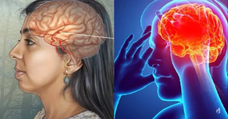 11 sintomas que indicam que você pode ter um aneurisma cerebral; fique atento