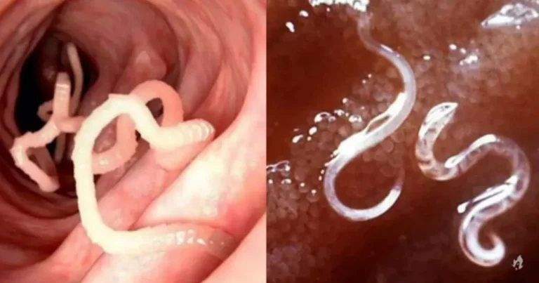Criança É Internada Com Vermes Parasitas Rastejando Em Sua Barriga Após Comer…