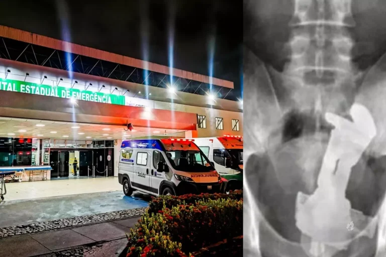 Homem é internado com objeto de quase 1 metro introduzido em parte íntima