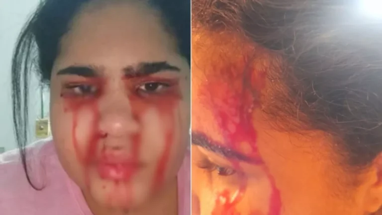 Jovem que sangra pelo nariz, boca, ouvidos e olhos passa a suar sangue e busca tratamento no Nordeste