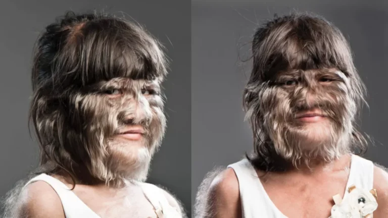 Adolescente eleita a mais peluda do mundo aparece sem pelos 15 anos após título