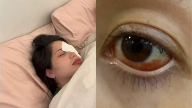 “Tive muito medo de ficar cega”, disse influenciadora que sofreu hemorragia ocular após usar lentes vencidas