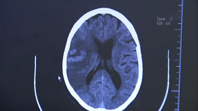 AVC tira a vida de um brasileiro a cada seis minutos; 80% dos casos poderiam ser evitados