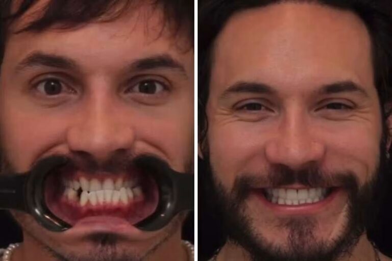 Eliezer relembra transformação nos dentes; veja o antes e depois
