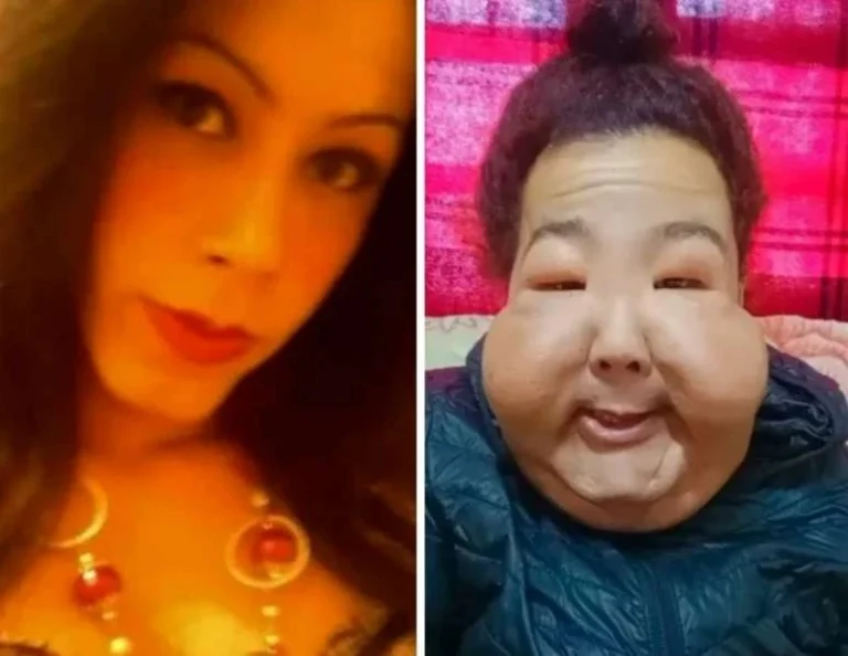 Influenciadora gaúcha inicia série de cirurgias reparadoras após aplicação clandestina