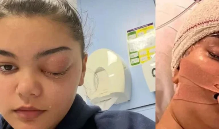 Começou como uma gripezinha: olho de adolescente salta como uma bola de golfe e ela descobre infecção bacteriana espalhada no cérebro