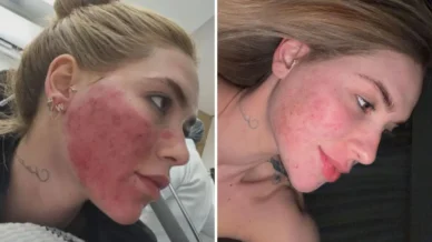 Virginia mostra rosto após procedimento que o deixou em carne viva; veja