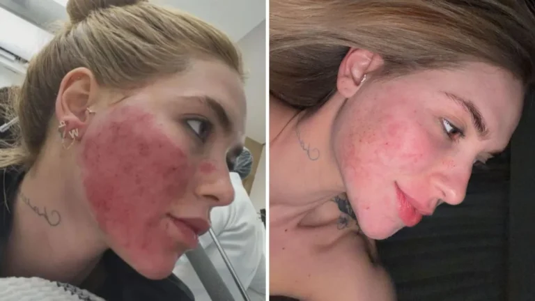 Virginia mostra rosto após procedimento que o deixou em carne viva; veja