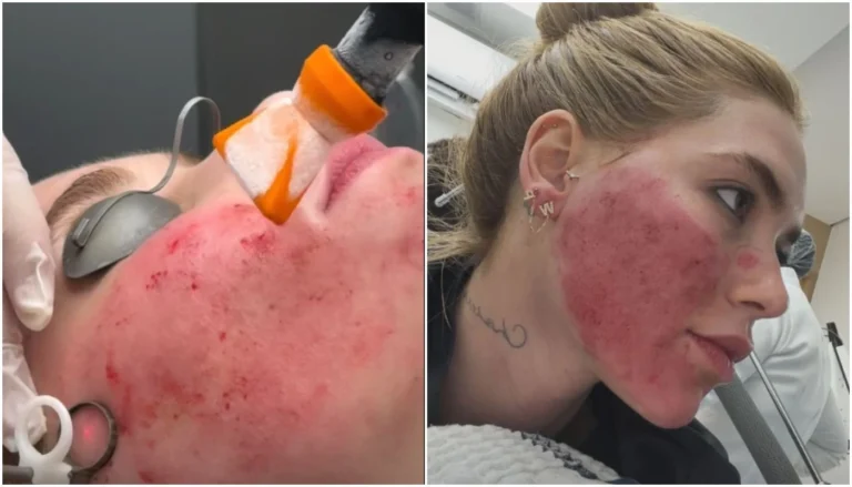 Rosto em carne viva de Virginia é normal? Especialista explica procedimento