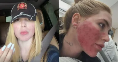 Virginia se arrepende de procedimento no rosto: 