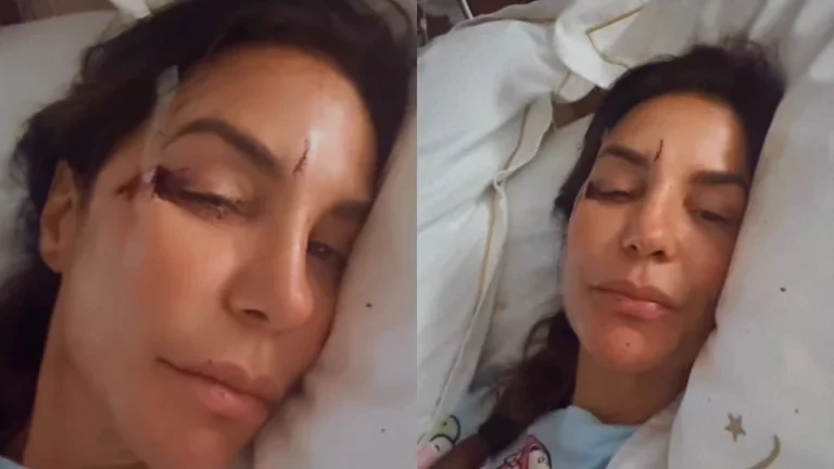 Ivete Sangalo é internada e mostra rosto machucado