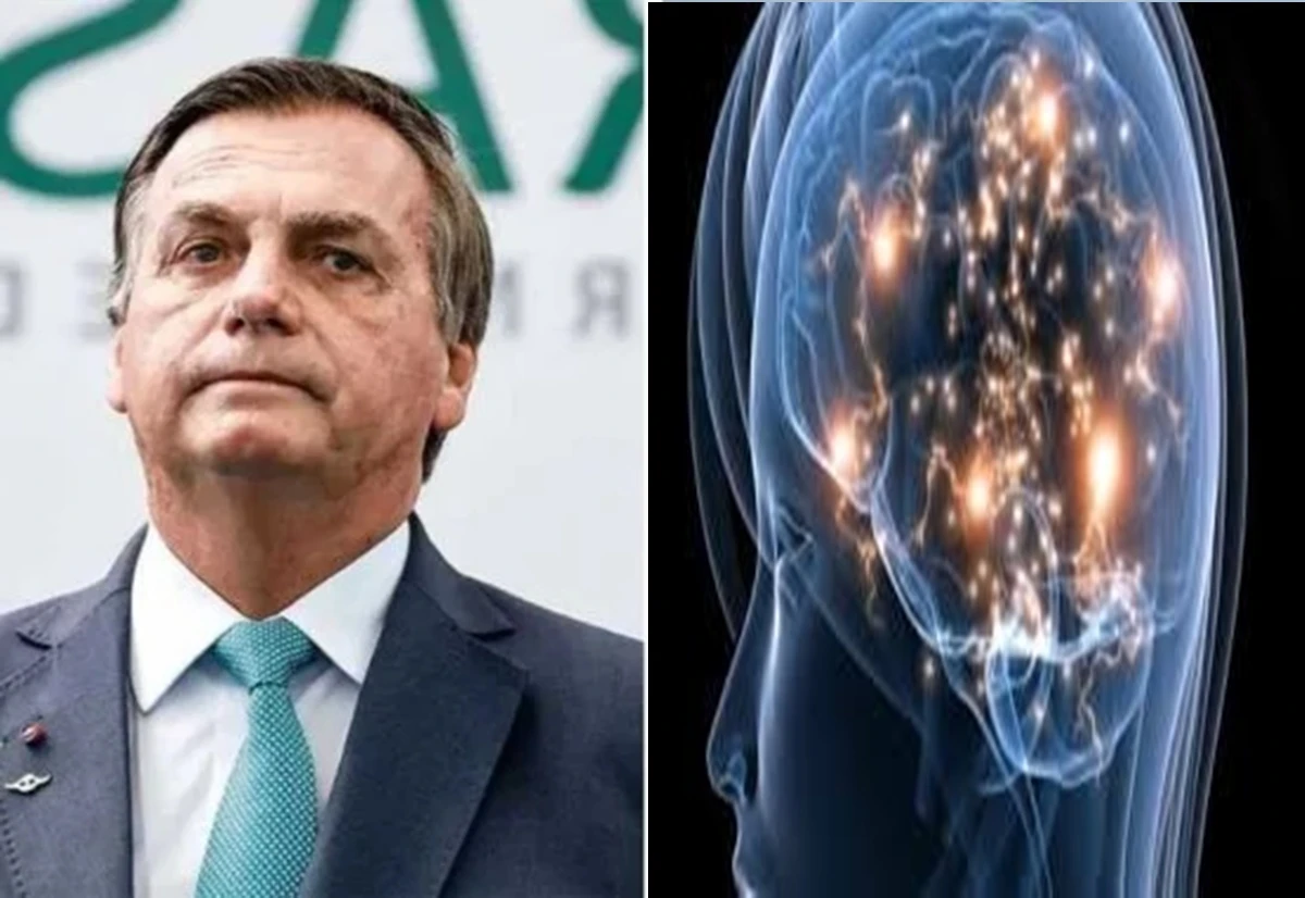 Estímulo Elétrico Craniano: Entenda o tratamento pedido pela defesa de Bolsonaro