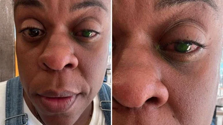 Cega? Cacau Protásio tem perda de visão após usar produto: Dor desesperadora