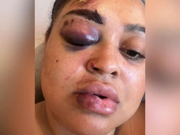 Ex-BBB sofre acidente grave e relata apagão: Não lembrava de nada