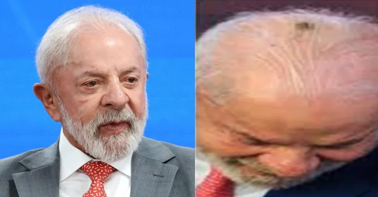 Queratose no couro cabeludo: Saiba o que é a doença que atinge presidente Lula