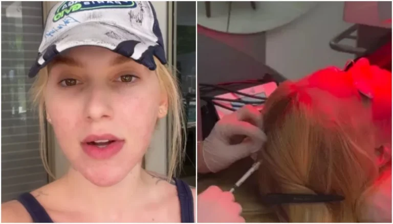 Virginia revela diagnóstico de alopecia areata e faz desabafo