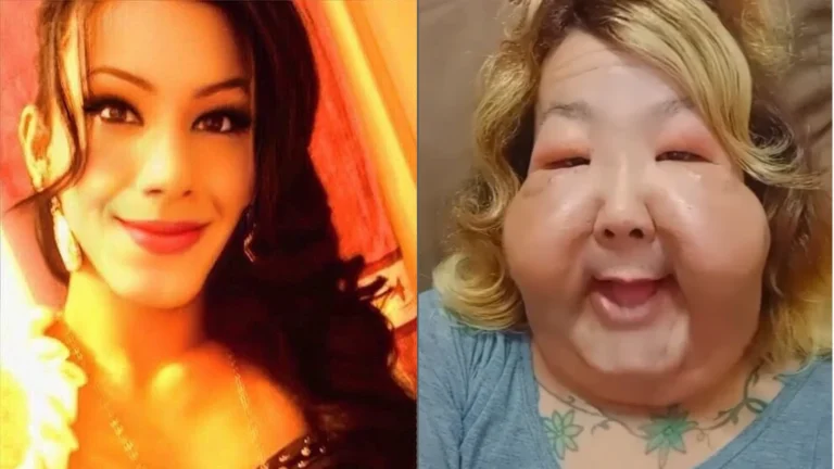 Veja antes e depois de Juju do Pix após seis meses de reconstrução facial