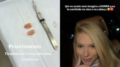 Virginia Fonseca: especialista explica procedimento de extração dos sisos
