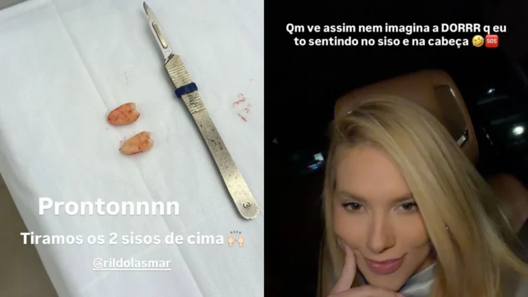 Virginia Fonseca: especialista explica procedimento de extração dos sisos